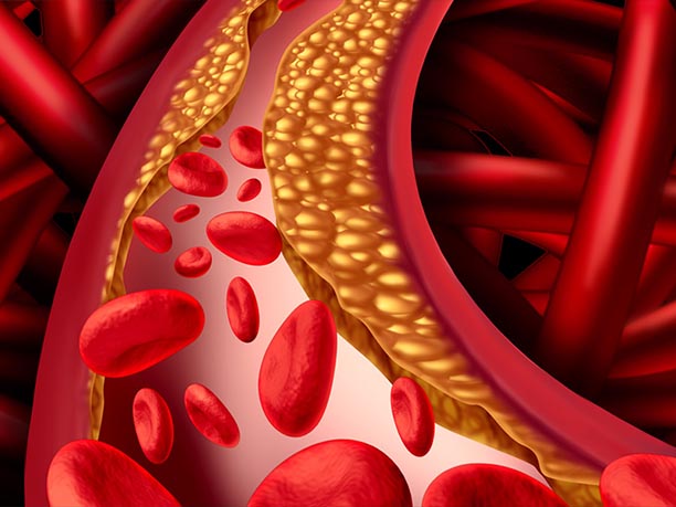 Illustration of how peripheral artery disease clogs veins and causes blood clots